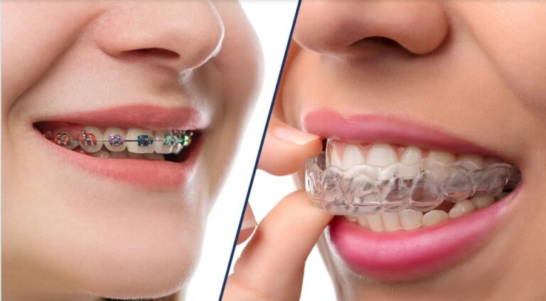 Invisalign vs Braces: Orthodontic Treatment | Brace America